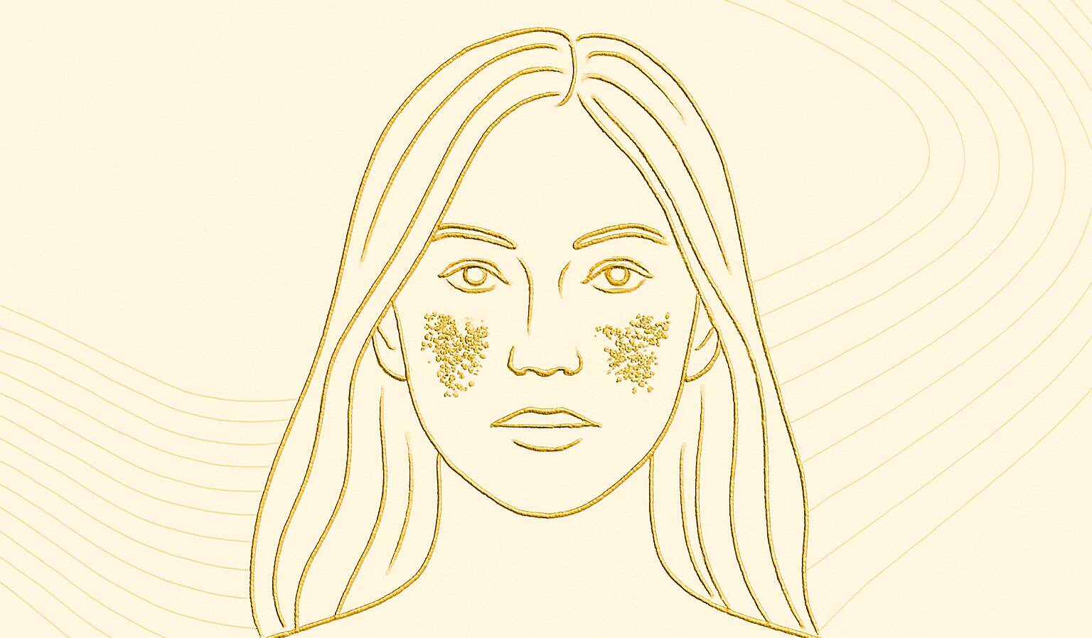 Melasma - image clinispa Guy watts