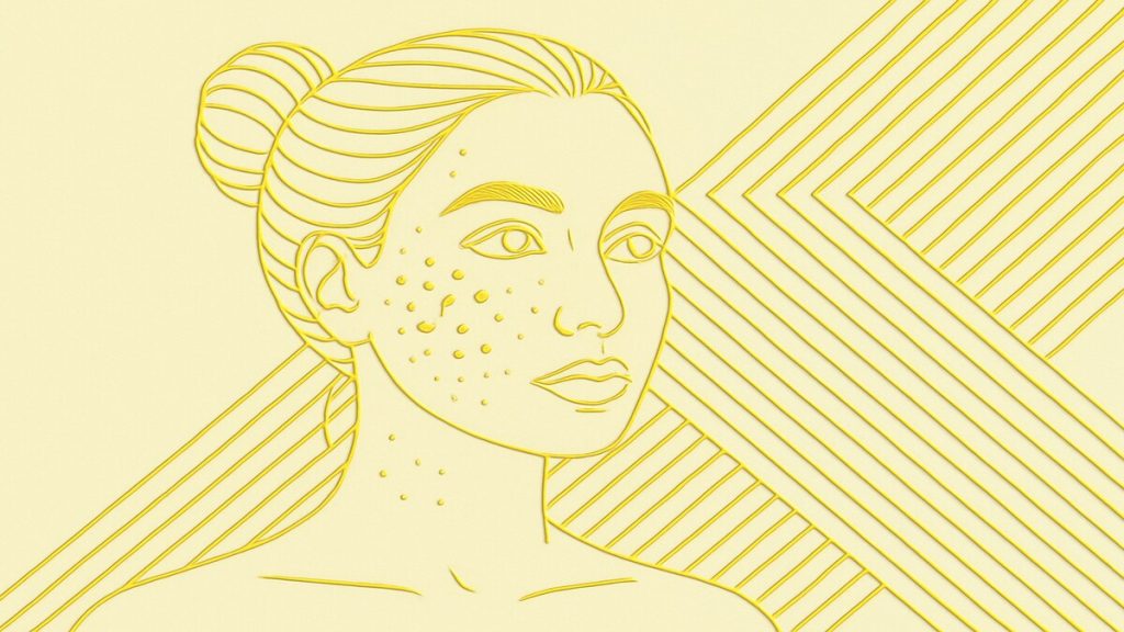 Inflammatory Acne and Acne Scarring